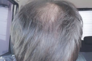 【超画像報】ワイ（24）の頭皮、ガチのマジで終わる・・・