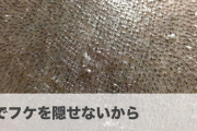 【閲覧注意】坊主にすればフケ治るんやないか？→結果ｗｗｗｗｗｗｗｗｗｗｗ