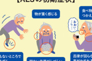 不治の難病『ALS』の進行を抑制する薬を慶応大がiPS細胞を使用し発見！！