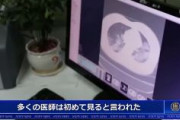 【中国】北京の医師「このような症状は初めて見る。感染者の肺の大部分が白くなっている。治療を放棄する」→感染者死亡