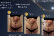 【朗報】ワイ、脂肪吸引によりどれだけ食っても太らない体質をゲットし人生の勝ち組へ…！
