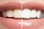 【ホームホワイトニング】実際の効果とは？