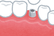 【質問】インプラント🦷ってどうなんや
