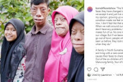 【インドネシア】顔が変形し“呪われている”と言われる家族が話題に