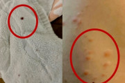 【悲報】韓国人「韓国で『トコジラミ』に刺されまくった被害者の画像がこちらです」「トコジラミ出没認証ショット」‥直接見たら衝撃　韓国の反応