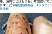 【原因不明】「IgA血管炎」足が1.5倍に腫れ上がる　痛みや紫斑などの症状