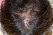 【朗報】俺のハゲ、治るｗｗｗ（※画像あり）