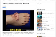 【中国】工場事故で左耳が取れた女性、すぐに手術できなかったので足の甲に付けて５ヶ月過ごす