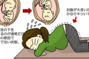 初産でいざ分娩となったら逆子だった　→助産師「足から出ちゃた！」医者「戻せ！いったん引っ込めよう！」　→「！？やめてー！」