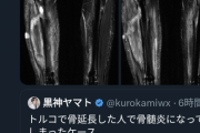 【悲報】例の骨延長の人、肉が『液状化』してとろけはじめる。もう終わりだよ…