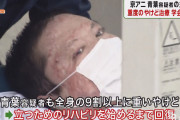 京アニ放火犯・青葉容疑者の主治医「正常な皮膚を培養して5回に分けて移植」 立つためのリハビリを始めるまで回復！