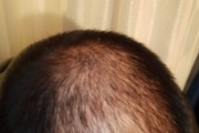俺の頭、ガチのハゲ（※画像あり）