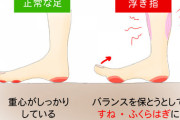 浮き指・かかと重心の人、集合！　改善方法ってあるの？