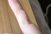 スマホの使いすぎで小指に変な跡あるんだが……みんなもあるよな…?