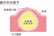 粉瘤の手術してきたけど質問ある？