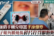 中国、スマホ充電器が爆発、 横で寝ていた男性が失明危機　まぶたが吹き飛び、眼骨の皮膚筋肉は壊死、角膜は焼かれた  [お断り★]