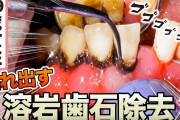 【悲報】「歯石取り」とかいう現代のガチ拷問、ヤバい…
