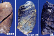 【閲覧注意】タバコを吸った肺、ヤバい。（おまえらの想像以上にヤバい）
