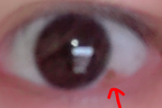 【画像】眼球にシミがあんだけど、これ大丈夫なやつ？