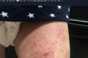 【悲報】自然派ママ「助けてｯ！息子の足が治らないのｯ！塩とか試してるのに！！！」