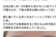 【悲報】クマ取り整形した女性、失明してしまう