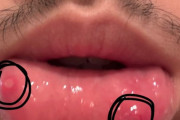 ワイ君、下唇の裏に口内炎が2個もできてしまい無事発狂（※画像あり）
