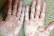 大人の「手足口病」が大流行か？想像を絶するかゆみと痛みで重症化…免疫力が低下してるからなるって、マジなの？