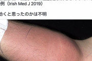 【悲報】腰痛になった男性、自分の腕に体液を注射してしまう