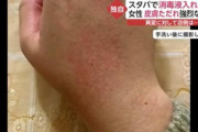 【悲報】スタバの消毒液を使った客、皮膚がただれてしまう