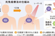 「第5のがん治療」、光免疫療法始まる ～光でがん細胞のみ破壊、免疫活性化も～ 世界初の実用化、スピード承認