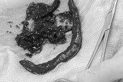 腹痛を訴える男性、膀胱から「ヒル」が摘出される　川で泳いだ際に尿道から侵入か　カンボジア