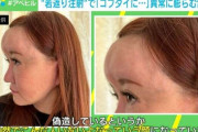 “若返り注射”でおでこが膨らみ「コブダイ」に！？ 当事者「よくこれで生きてたな。額の限界を感じた…」 PRP＋bFGFとは？