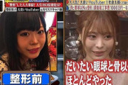 【画像】大人気ユーチューバーさん整形手術を告白　顔面総工事費1000万円