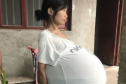 【衝撃】中国人女性、お腹が巨大風船のように膨れ続ける謎の奇病にかかる