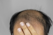 【悲報】ハゲ治療に行った結果ｗｗｗｗｗｗｗｗ