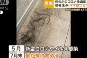 【緊急】コロナ後遺症の『脱毛』、完全に舐めてたわ…