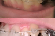 【画像】歯列矯正はじめた結果wwwwwwwwwwwwwwwwwwww