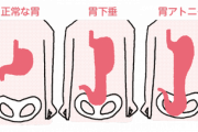 【画像】『胃下垂』を放置し続けた人、こうなる…