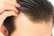 20代でハゲる男性の悪習トップ3が判明する『ストレス・喫煙・アルコール』