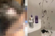 【画像】ヘアコンディショナーに脱毛剤を意図的に混入させるという凶悪事件発生！　21歳女性が使用して無残な姿になってしまう・・・