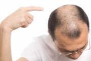 【ハゲ】「薄毛の許せる有名人」といえば？　「男性の薄毛」について男女890人調査 (AGA治療関連)
