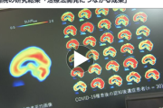 【速報】コロナ後遺症30人の脳を調べた結果→『とんでもない事実』が判明