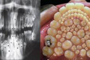 【画像】過剰歯とかいう病気怖すぎワロタｗｗｗｗｗｗｗｗｗｗｗｗｗｗｗｗｗｗｗｗｗｗｗ