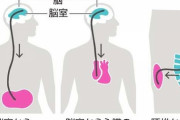 「治せる認知症」の手術　負担少ない手法、じわり広がる