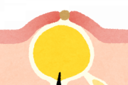 【恐怖】粉瘤潰したら中から青い塊が出てきたんだがｗｗｗｗｗｗｗｗｗ