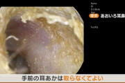 医者「耳掃除を家でやってはダメ！耳クソは病院で取ってもらえ」