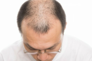 【ハゲに朗報】氏んだ毛根を復活させる方法！！！！