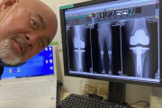 【画像あり】プロレスラー武藤敬司さんの膝のレントゲンwww