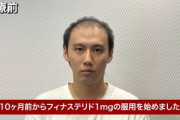 【画像】薄毛治療薬のフィナステリド、ガチで効果がすごいwwwwwwwww