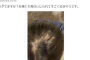【画像】17歳男性、髪の毛に悩む「これハゲてますか？友達にもいじられてすごく泣きそうです」(ﾊﾟｼｬｯ